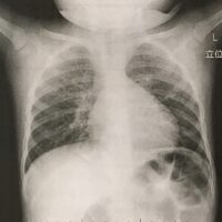 バリウムが肺に入ると死ぬ？